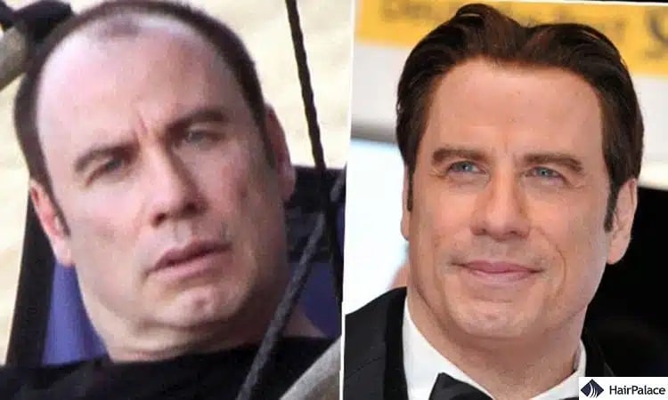 John Travolta Haartransplantation vorher und nachher
