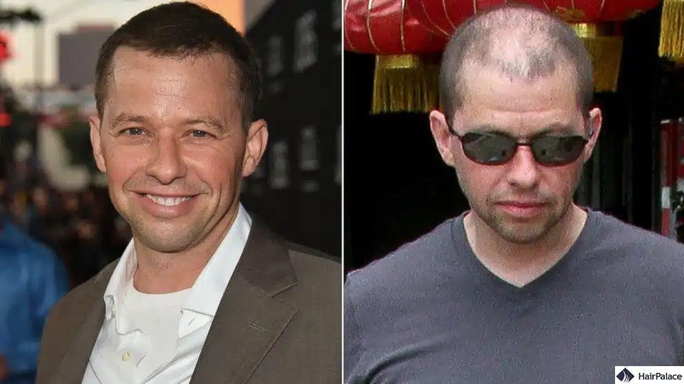 Jon Cryer Haartransplantation vorher und nachher