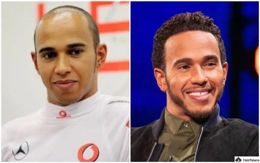 Lewis Hamilton Haartransplantation vorher und nachher