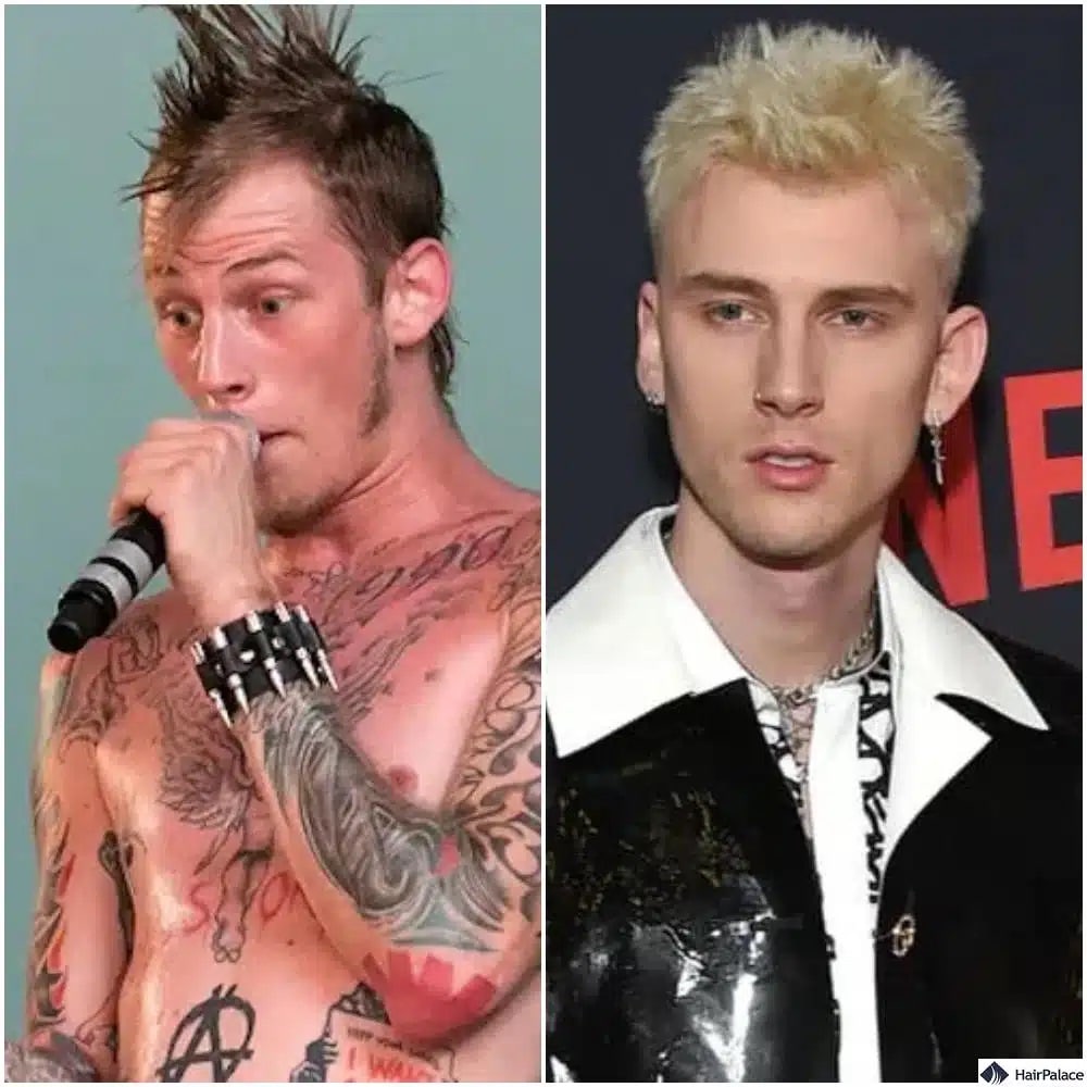 Machine Gun Kelly Haartransplantation vorher und nachher