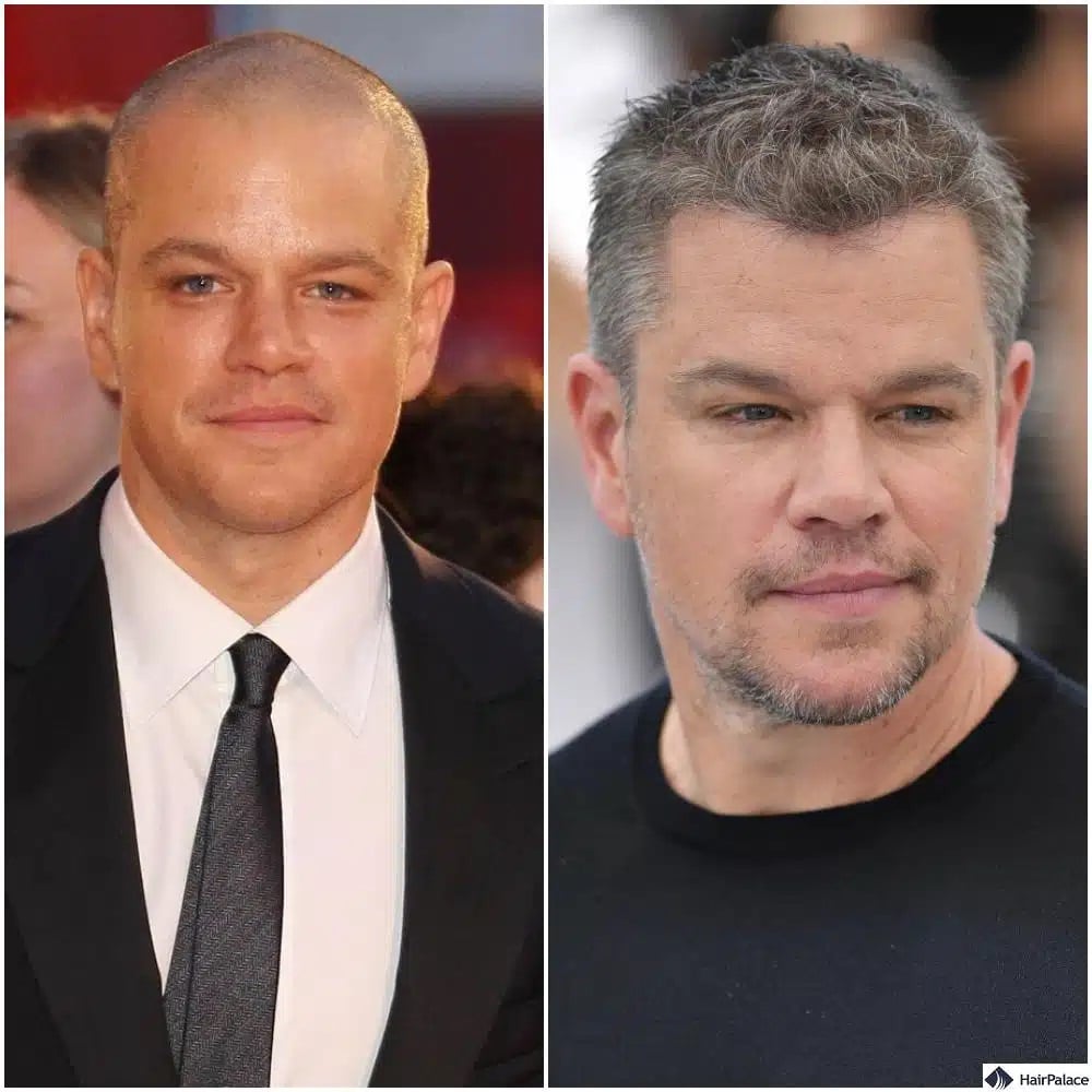 Matt Damon Haartransplantation vorher und nachher