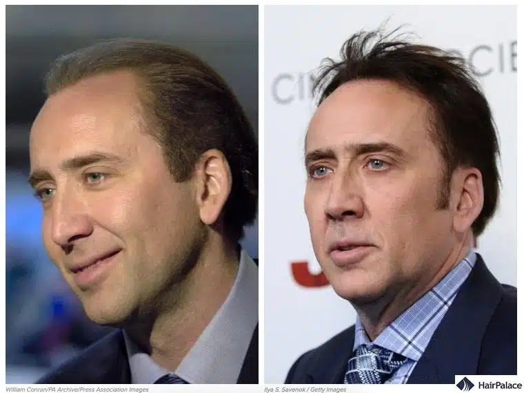 Nicholas Cage Haartransplantation vorher und nachher