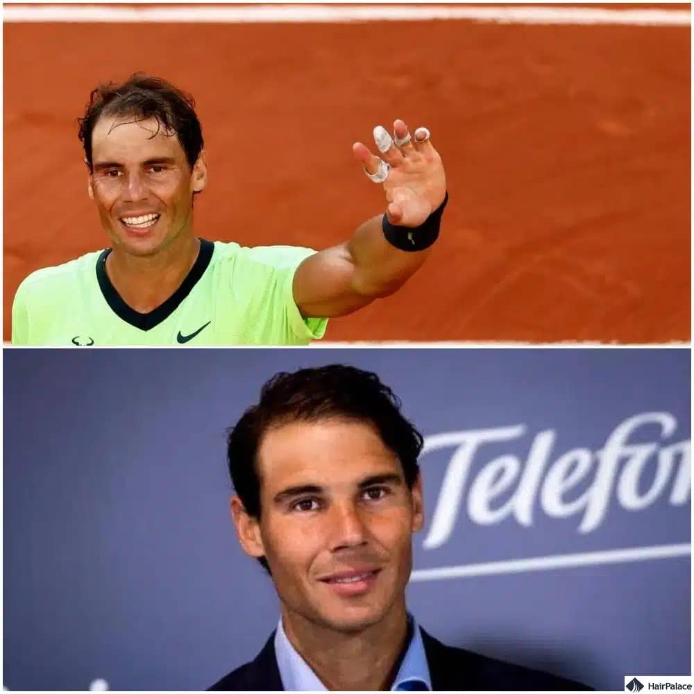 Rafael Nadal Haartransplantation vorher und nachher