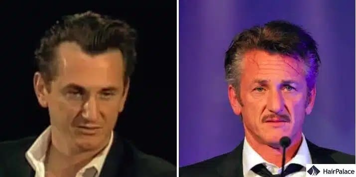 Sean Penn Haartransplantation vorher und nachher