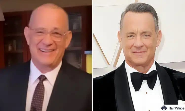 Tom Hanks Haartransplantation vorher und nachher