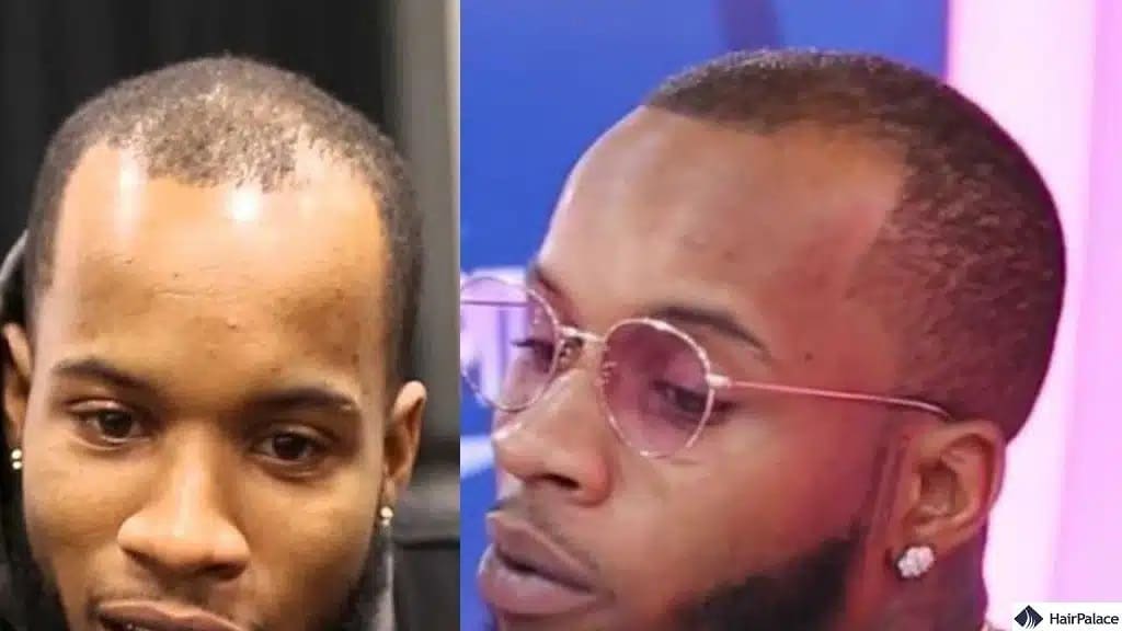 Tory Lanez Haartransplantation vorher und nachher