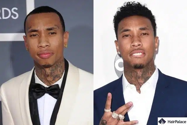 Tyga Haartransplantation vorher und nachher