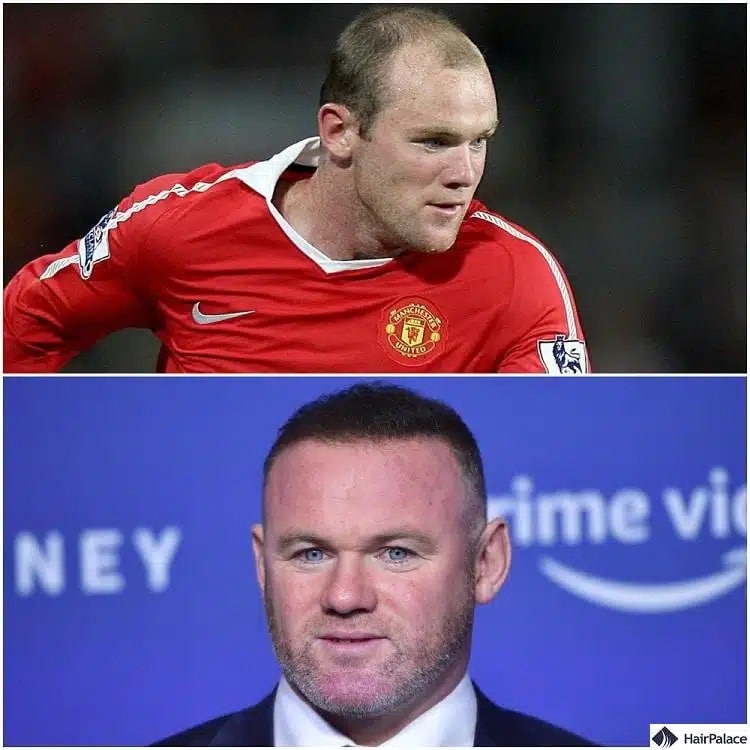 Wayne Rooney Haartransplantation vorher und nachher