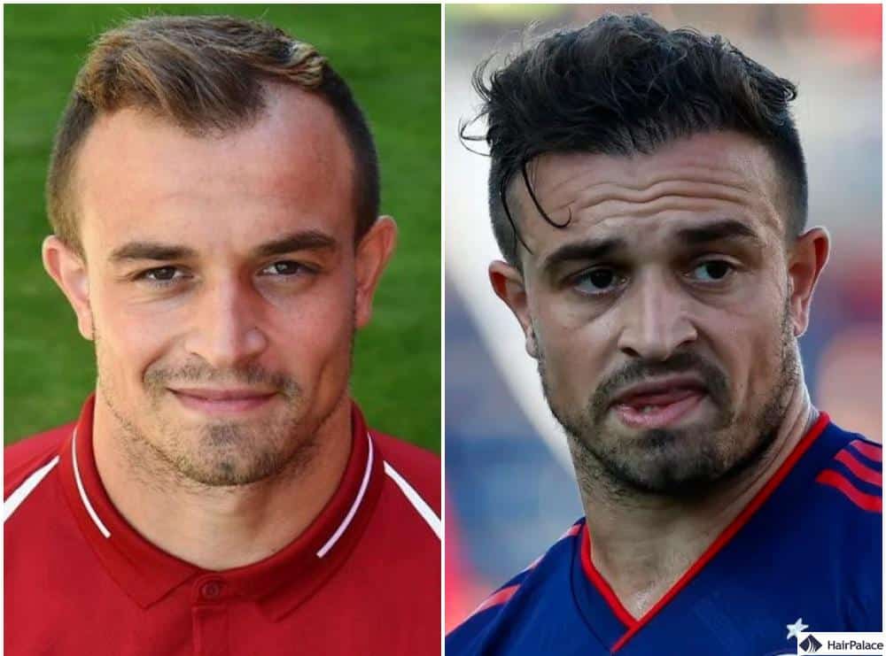 Shaqiri nach Fue-Haartransplantation mit üppigen Locken