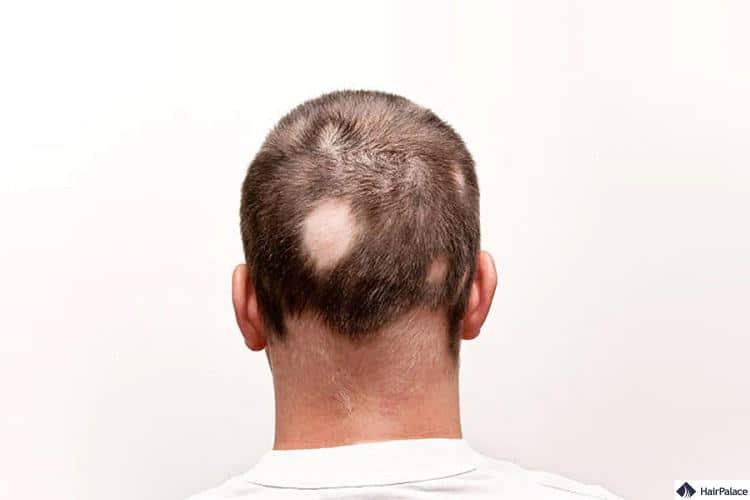 Alopecia areata ist eine Autoimmunerkrankung, die zu Haarausfall führen kann