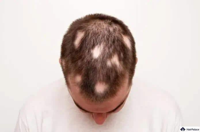 Eine Glatze kann das Ergebnis einer Alopecia areata sein
