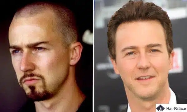 Edward Norton Haartransplantation vorher und nachher