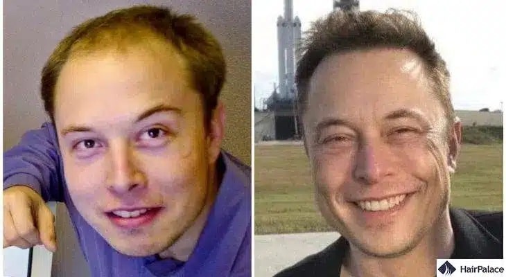 Elon Musk Haartransplantation vorher und nachher