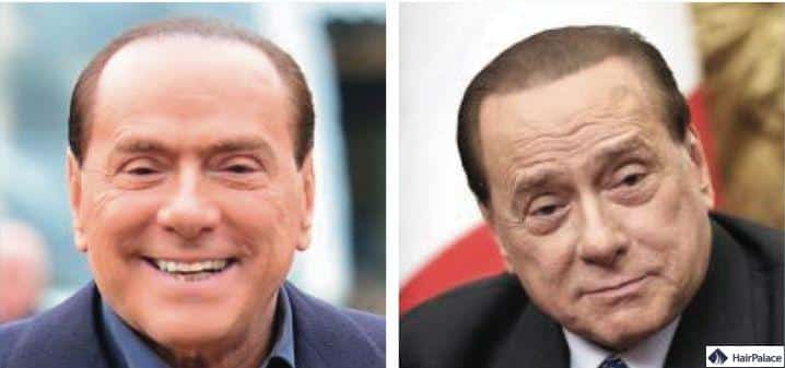 Silvio Berlusconi
Haartransplantation vorher und nachher