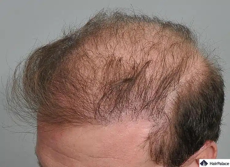 eine fehlgeschlagene Haartransplantation kann zu einem schlechten Haarwachstum führen