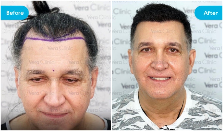 haartransplantation türkei vorher nachher veraclinic