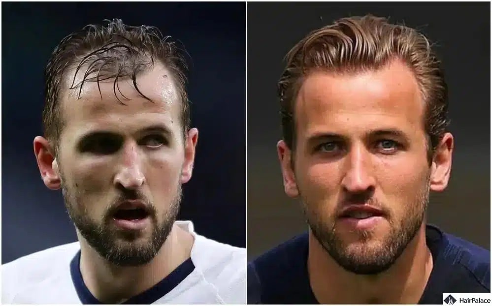 Harry Kane Haartransplantation vorher und nachher