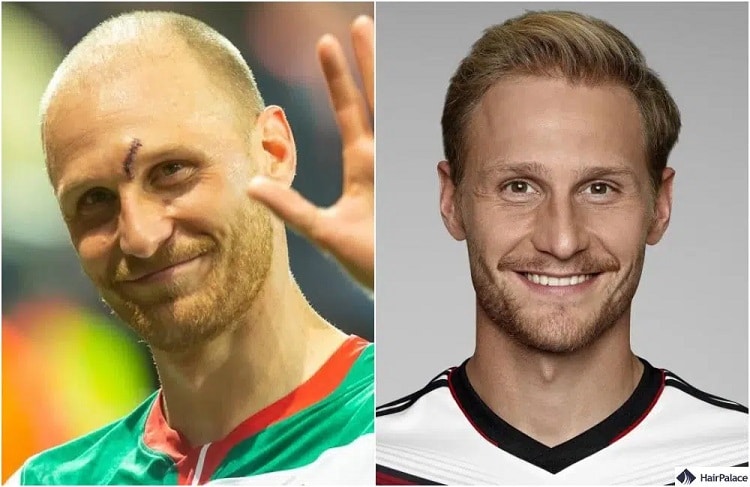 Benedikt Höwedes Haartransplantation vorher und nachher