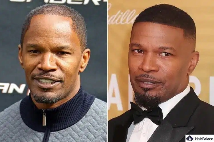 Jamie Foxx Haartransplantation vorher und nachher