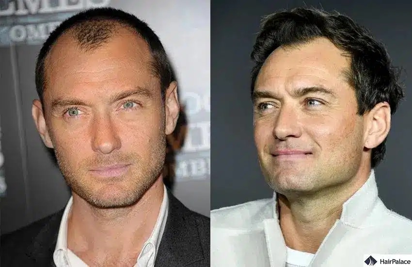 Jude Law Haartransplantation vorher und nachher