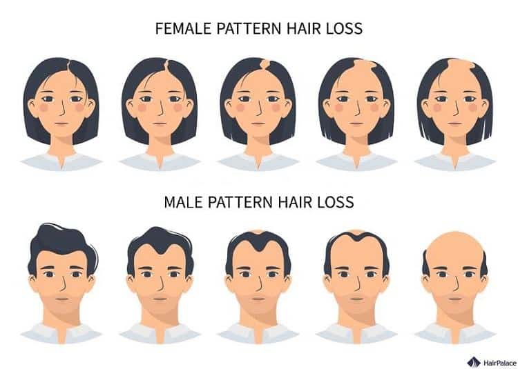 die Unterschiede zwischen männlichem und weiblichem Haarausfall