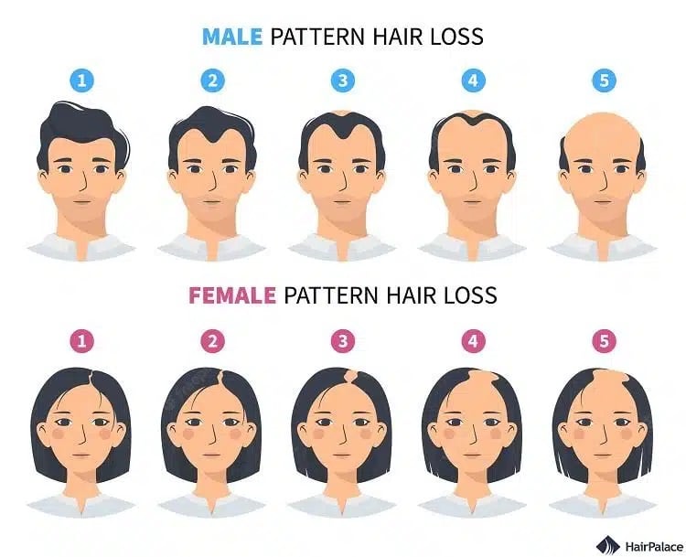 die Unterschiede zwischen männlichem Haarausfall und weiblichem Haarausfall