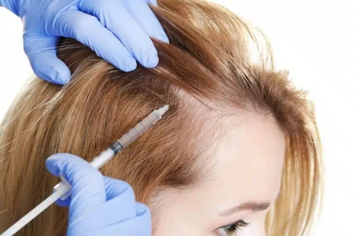 Die PRP-Behandlung gegen Haarausfall kann eine Alternative zu einer Haartransplantation Frauen sein