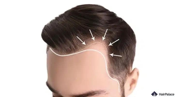 Raue Haarstylingpraktiken können Traktionsalopezie verursachen