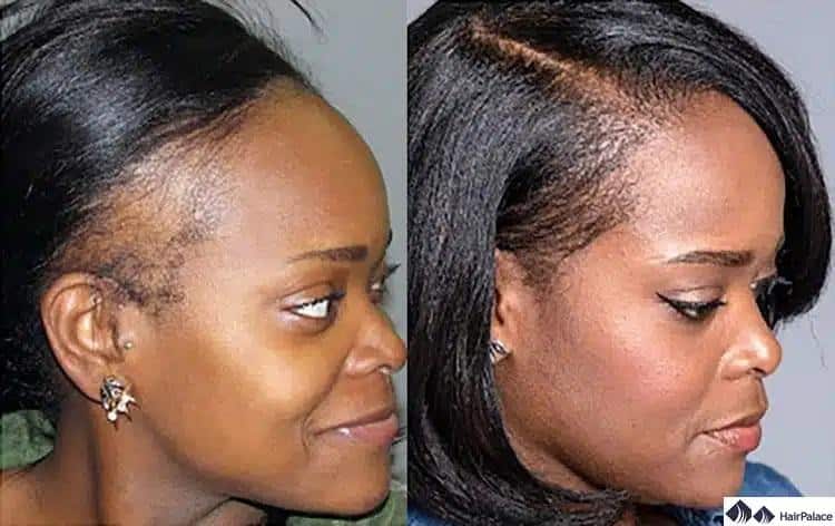 weibliche haartransplantation vorher und nachher