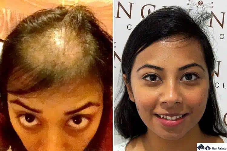 Haartransplantation bei Frauen vor und nach den Ergebnissen