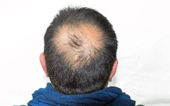 immer weniger Haare im Scheitelbereich zu bemerken, kann ein Zeichen für Glatzenbildung mit 20 sein