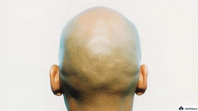 Glatze im Alter von 20 Jahren – Haartransplantation in der Haarklinik HairPalace