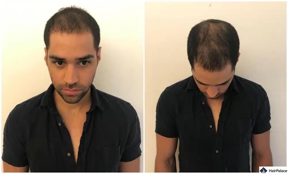 Der Haarwuchs tritt drei Monate nach der Haartransplantation auf.