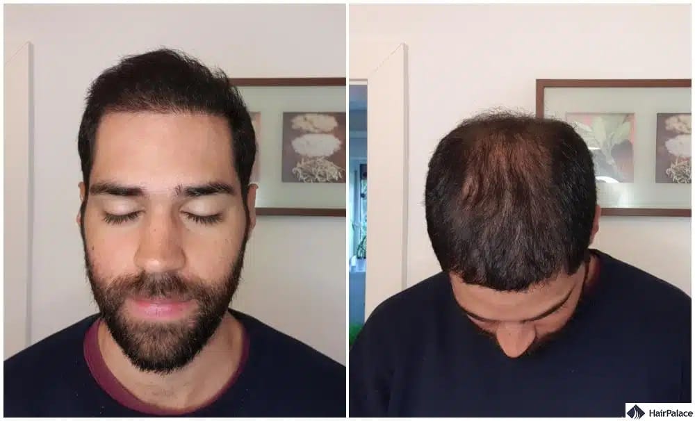 Ihr Haar sollte 6 Monate nach einer Haartransplantation weiterhin gut wachsen.