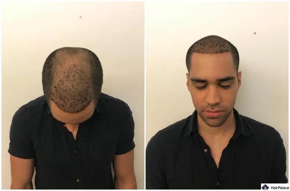 So sieht eine Haartransplantation nach einer Woche aus