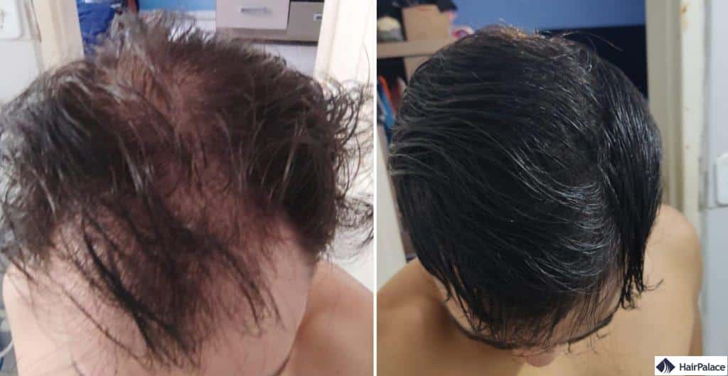 diffuser haarausfall symptome