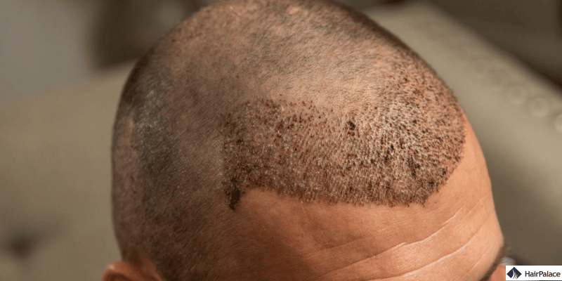 haartransplantation geheimratsecken ist der beste Weg, um den Haaransatz wiederherzustellen