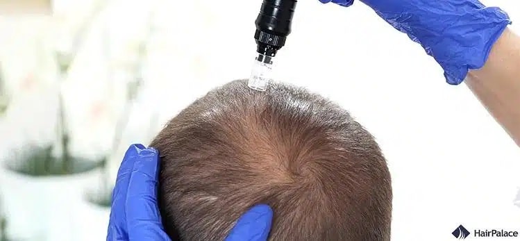 Microneedling Haare hat mehrere Vorteile