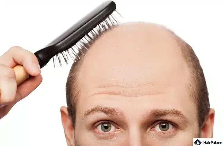 Schuppen führen selten zu Haarausfall oder Glatze