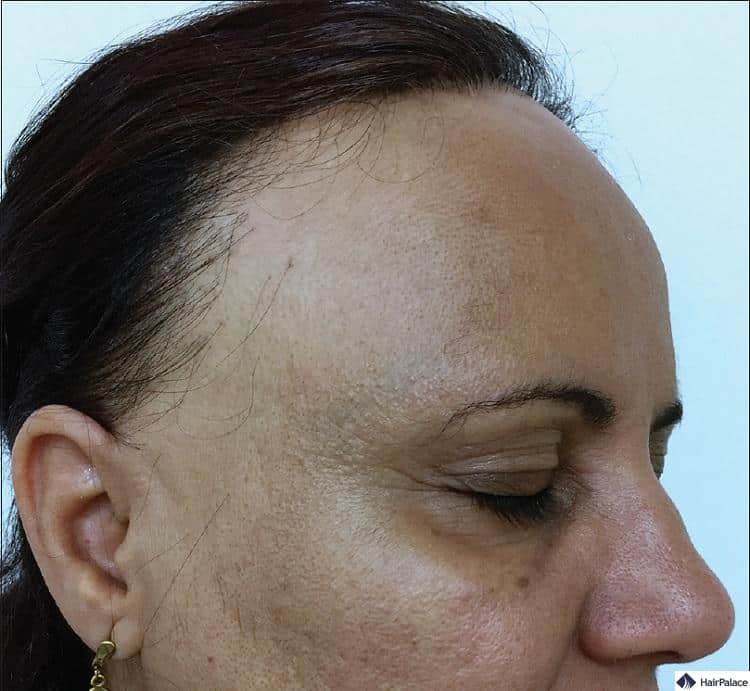 so präsentieren sich die Symptome der frontal fibrosierende Alopezie