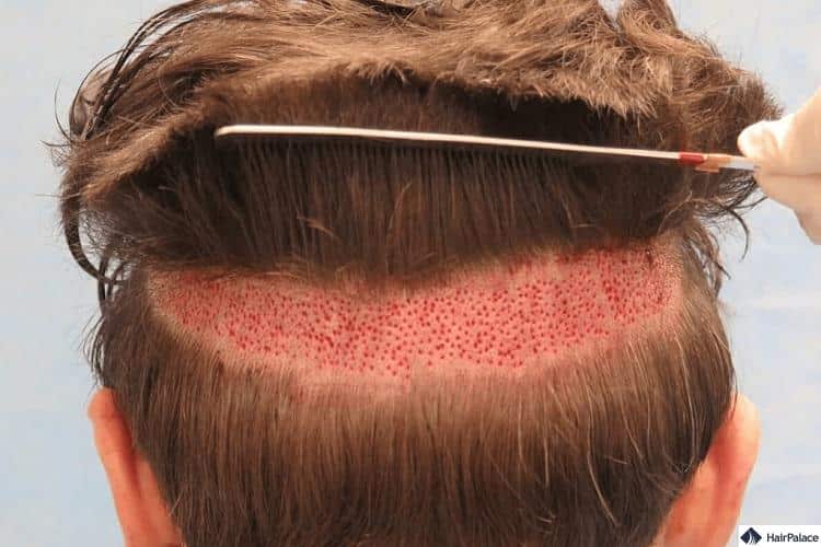Haartransplantation ohne Rasur kann zu einem lückenhaften Spenderbereich führen