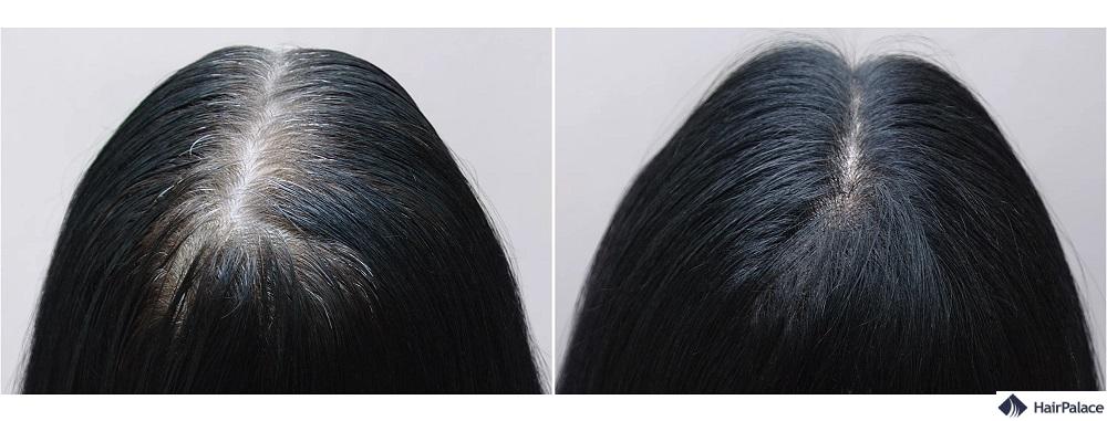 Biotin gegen Haarausfall