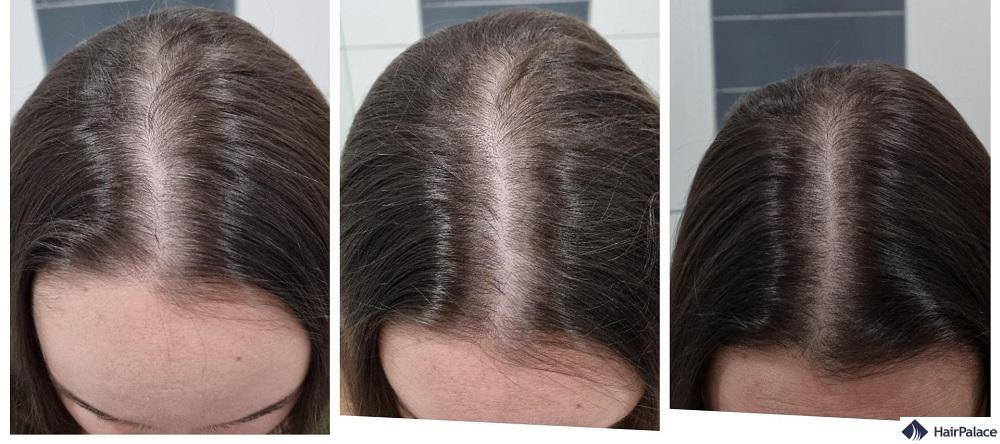 Biotin für dünner werdendes Haar