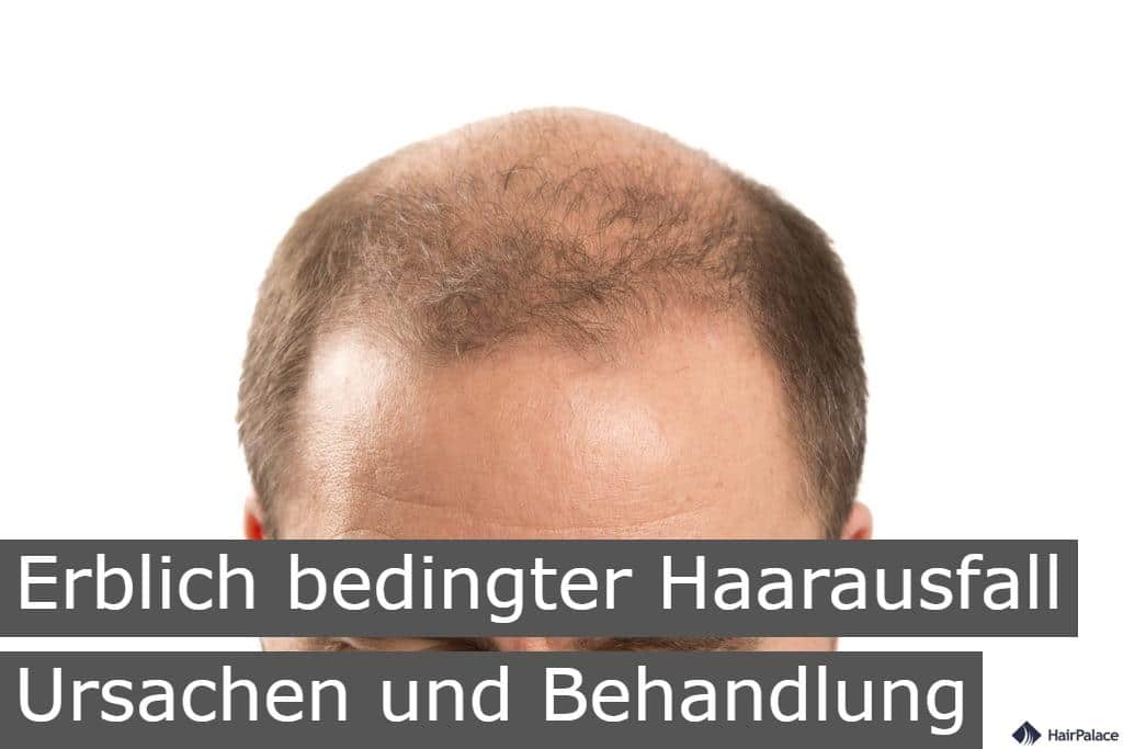 Erblich bedingter Haarausfall Ursachen und Behandlung