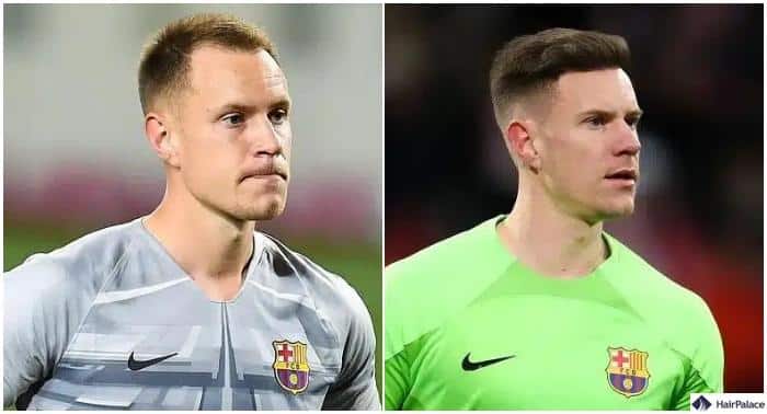 ter stegen haare vorher nachher haartransplantation