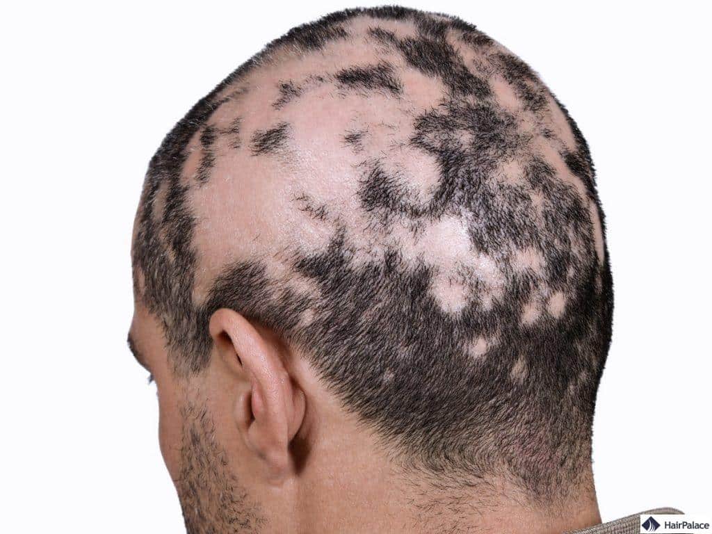 Kreisrunder Haarausfall kann jederzeit wieder auftreten