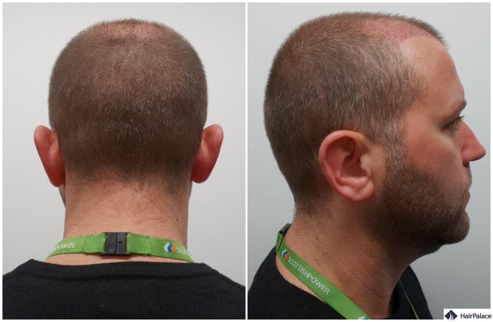 Spenderbereich 3 Monate nach der Haartransplantation