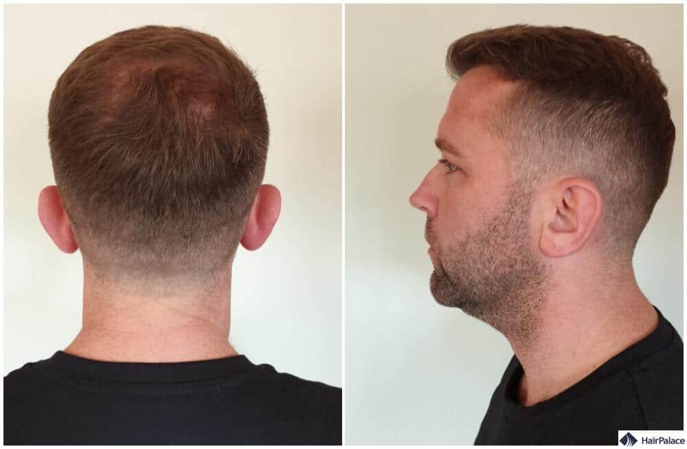 Spenderbereich 6 Monate nach der Haartransplantation