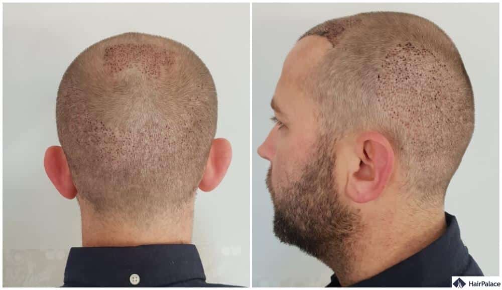 Krustenbildung im Spenderbereich nach Haartransplantation