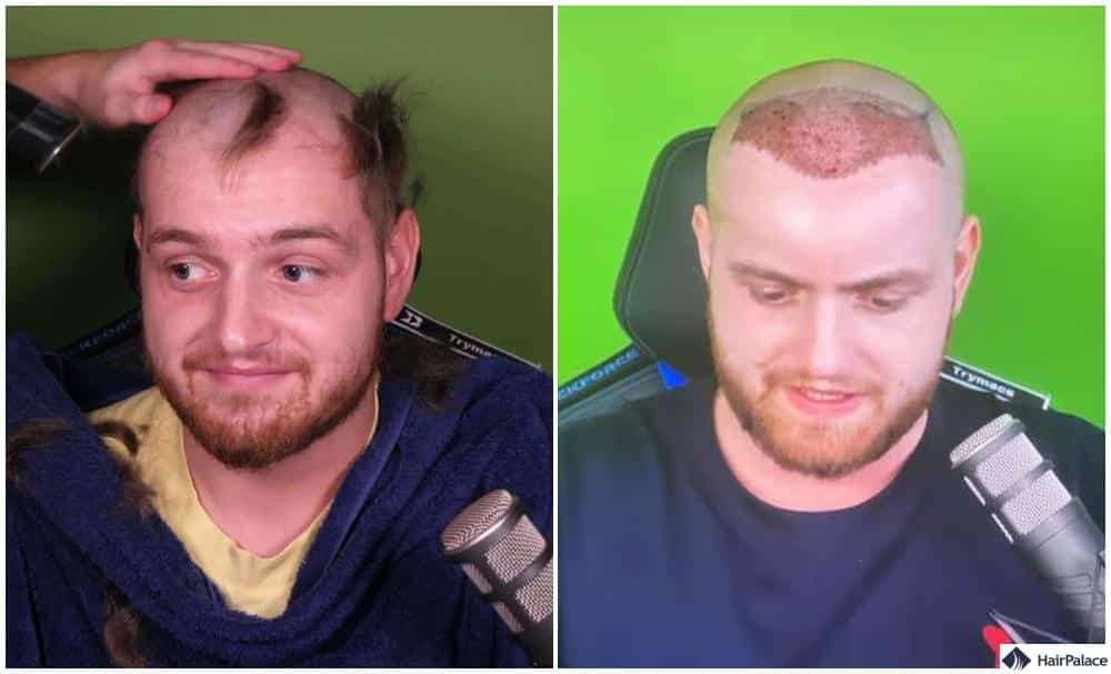 die von Trymacs gewählte Methode der Haartransplantation